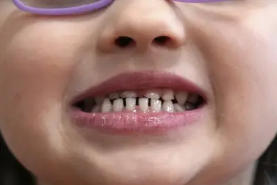 RFK’s War on Fluoride Could Lead to 50 Million More Tooth Decay Cases, Study Suggests